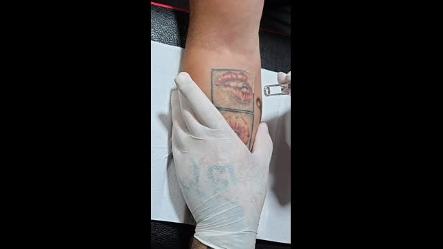 Tattoo removal