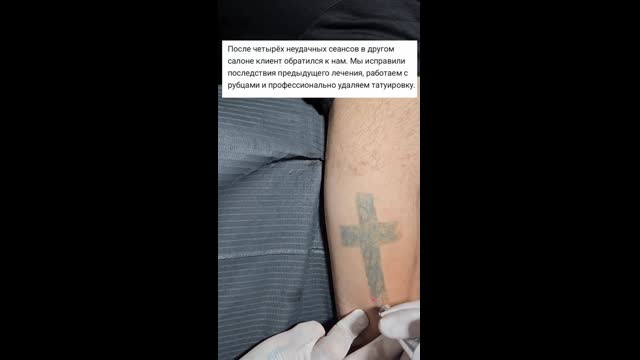 Tattoo removal