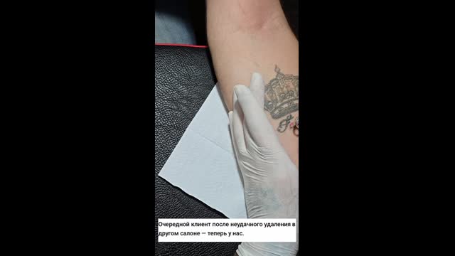 Tattoo removal