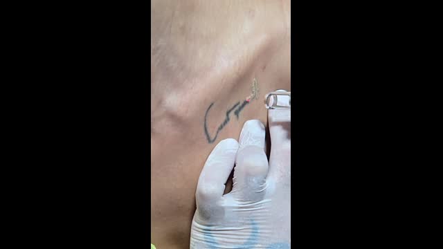 Tattoo removal