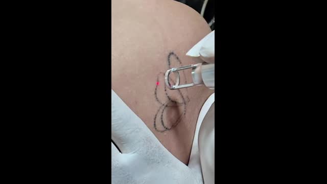 Tattoo removal