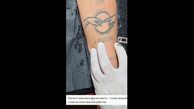 Tattoo removal