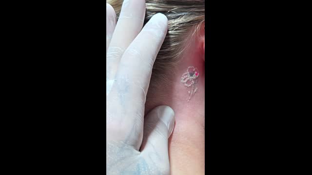 Tattoo removal