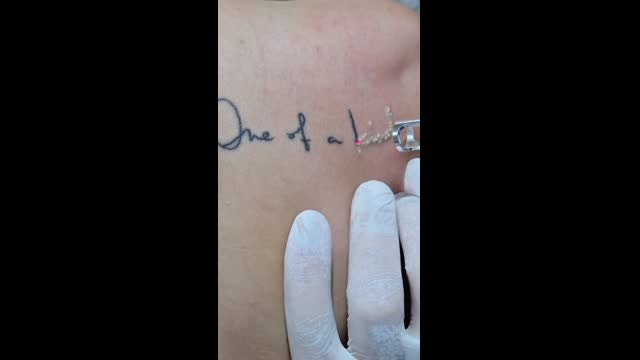 Tattoo removal