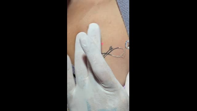 Tattoo removal