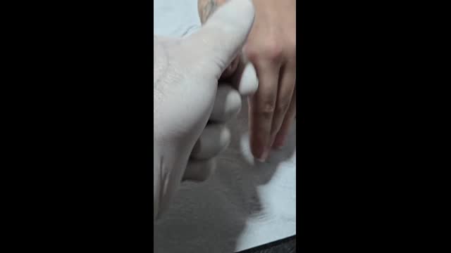 Tattoo removal