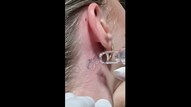Tattoo removal