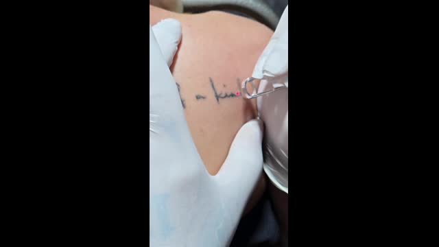 Tattoo removal