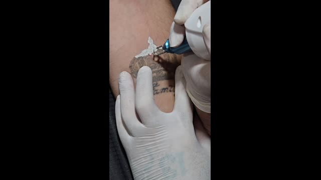 Tattoo removal