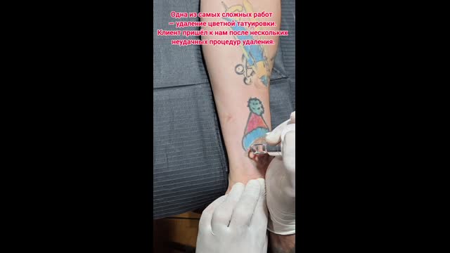 Tattoo removal
