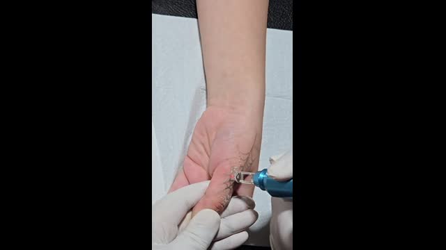 Tattoo removal