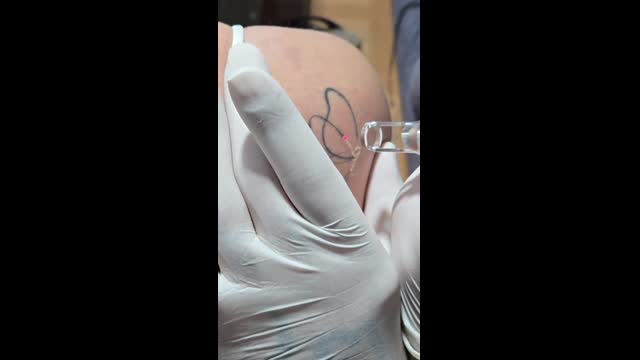 Tattoo removal