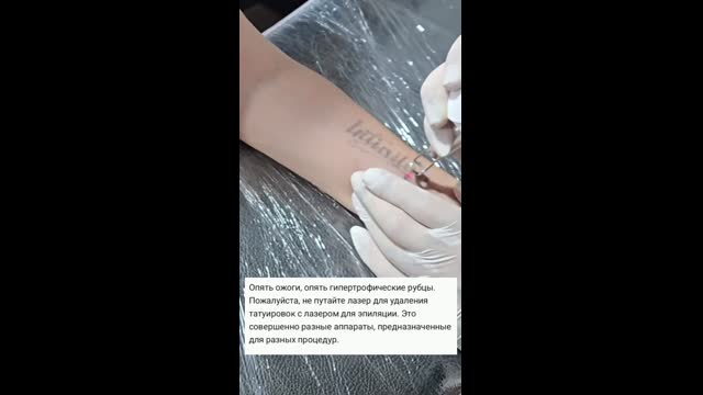Tattoo removal
