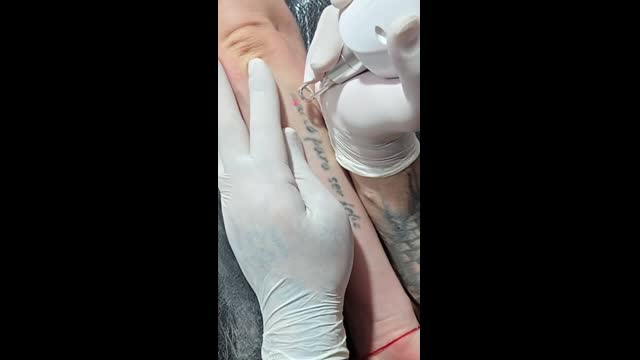 Tattoo removal