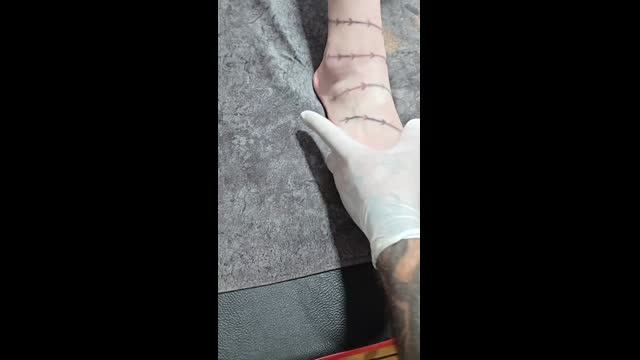 Tattoo removal