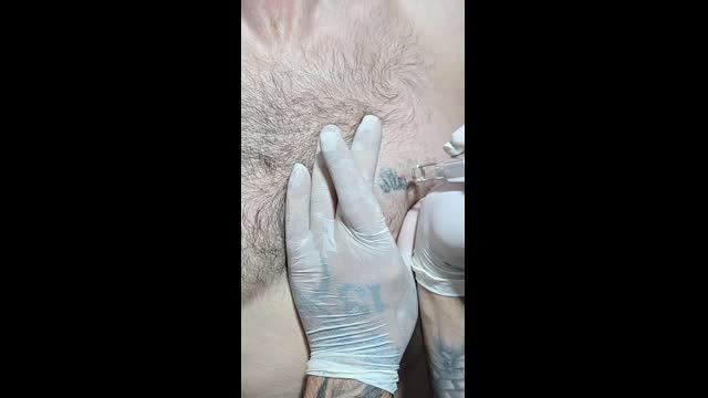 Tattoo removal