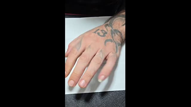Tattoo removal