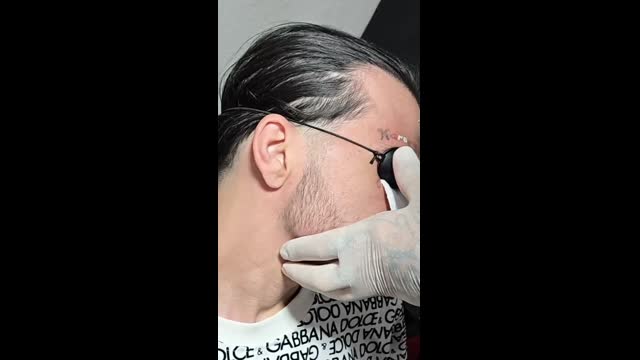 Tattoo removal