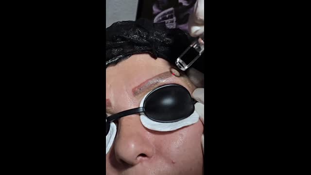 Tattoo removal