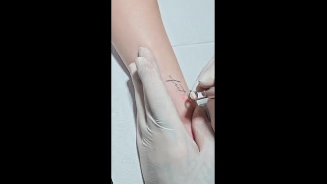 Tattoo removal