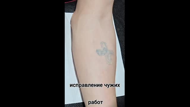 Tattoo removal