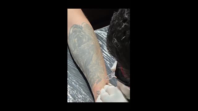 Tattoo removal