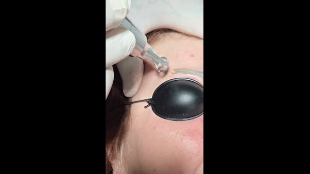 Tattoo removal