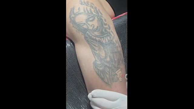 Tattoo removal