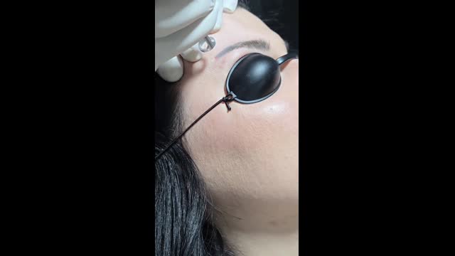 Tattoo removal