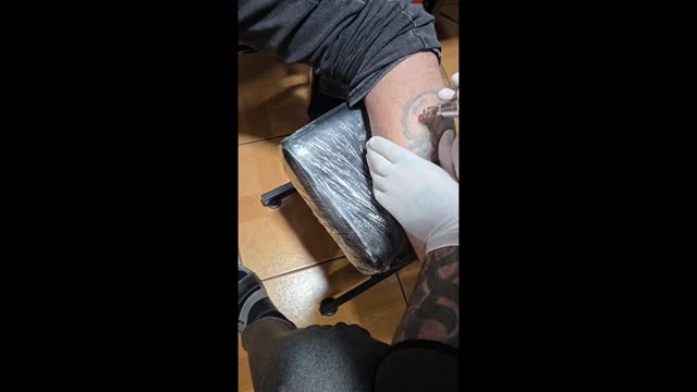 Tattoo removal