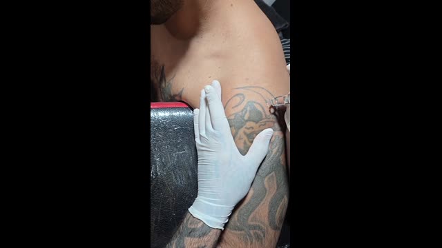 Tattoo removal