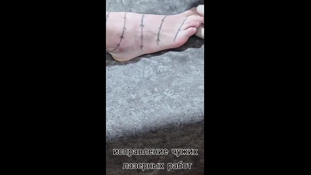 Tattoo removal