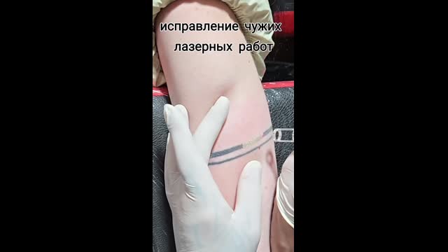 Tattoo removal