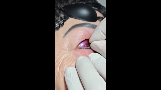 Tattoo removal
