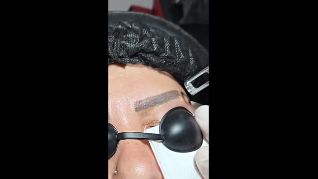 Tattoo removal