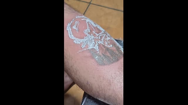 Tattoo removal