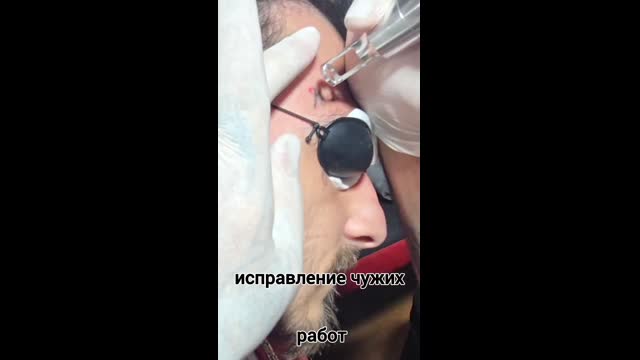 Tattoo removal