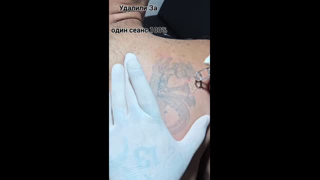 Tattoo removal